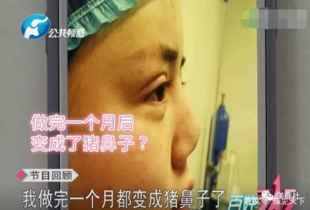 梨花雨医疗美容院做完整鼻手术变成猪鼻子携记者维权被怼无聊